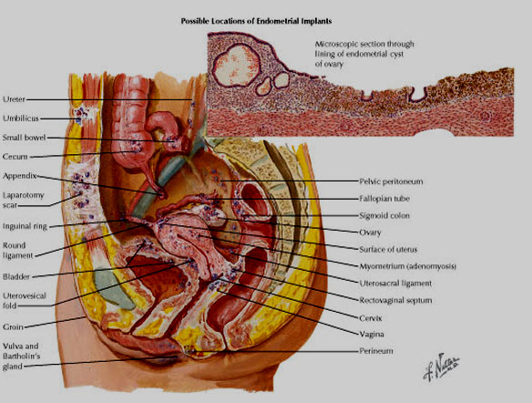 Endometriosis –