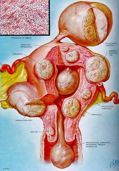 myomectomy-vbgyn