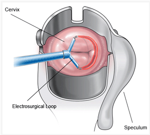 Leep Procedure Vbgyn Com