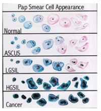 Abnormal Pap Smears – VBGYN.com