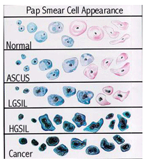 Pap Smear Abnormal Result