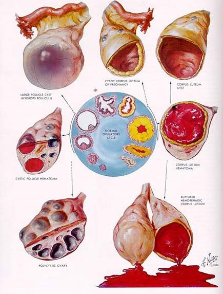 Hemorrhagic Ovarian Cysts: When to Worry about Ovarian Cysts and Ruptures